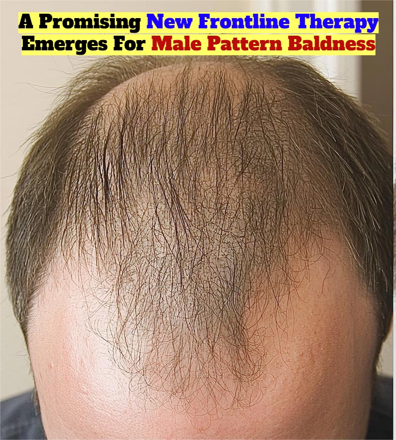 Acne Drug As Baldness Cure? The Science Behind The Hype